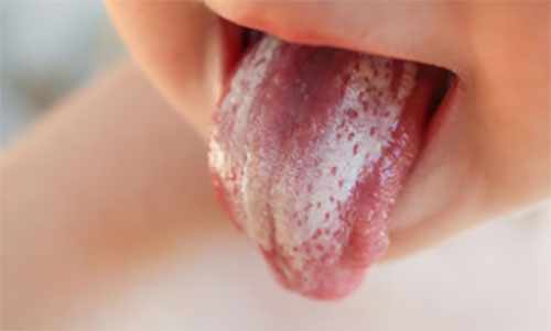 Обложенный белым налетом язык ребенка