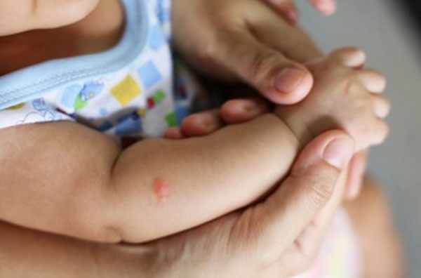 Воспаленный участок на коже маленького ребенка после укуса комара
