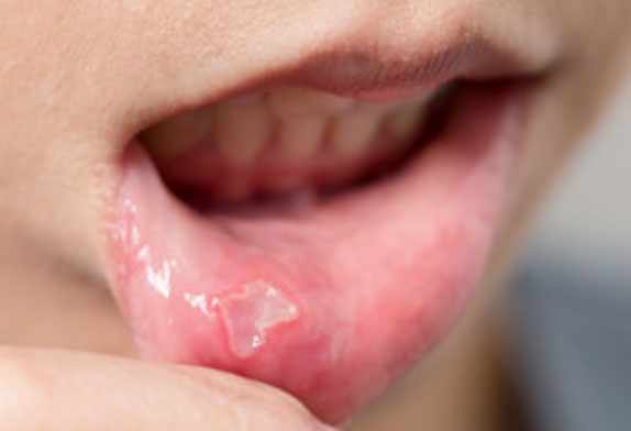 Афтозный стоматит на губе ребенка (с внутренней стороны)