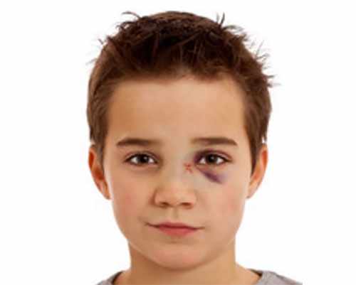 Мальчик с переломом носа и появлением синюшности под одним глазом