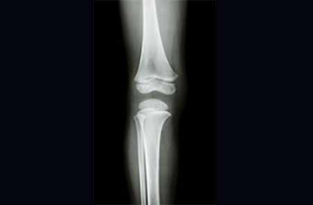 Рентгеновский снимок коленного сустава ребенка