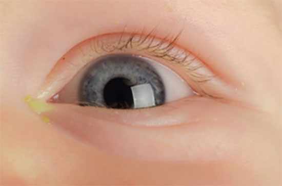 Глаз ребенка, с которого выделяется желтоватое вещество