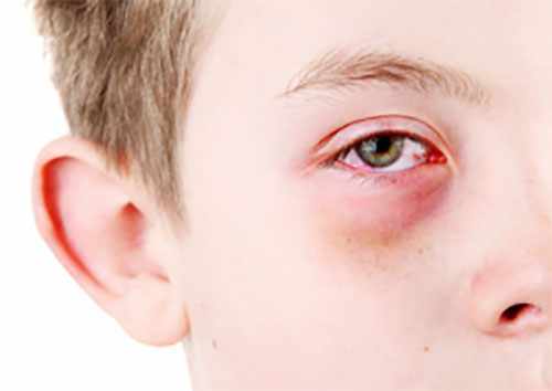 Мальчик с признаками аллергического конъюктивита