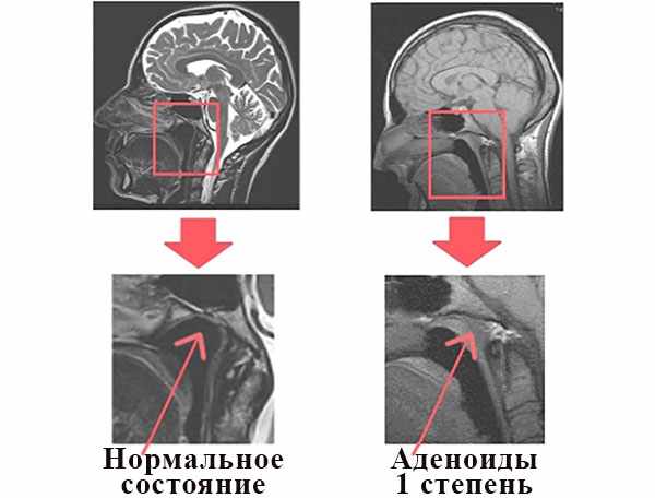 Рентгеновские снимки черепа с увеличением области носоглотки: норма и аденоиды 1 степени