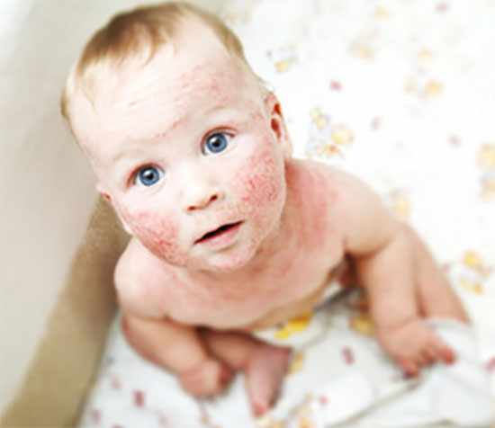 У ребенка на лице и шеи явные признаки дерматита