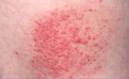 Аллергическая сыпь на коже