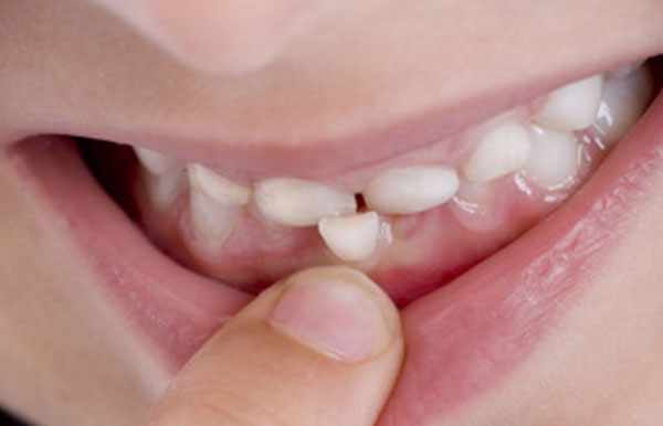 Рот ребенка с шатающимся зубом