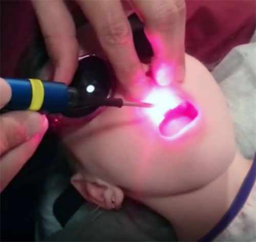 Ребенку проводится физиопроцедура для заживления ранки после надреза