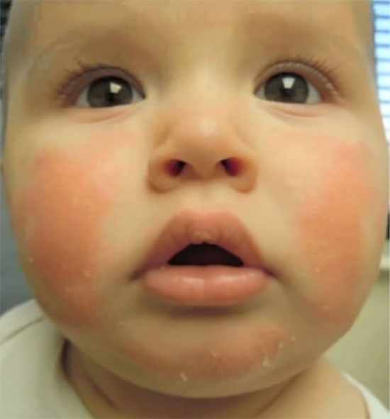 Малыш с красными щечками. На подбородке наблюдается шелушение кожи и краснота