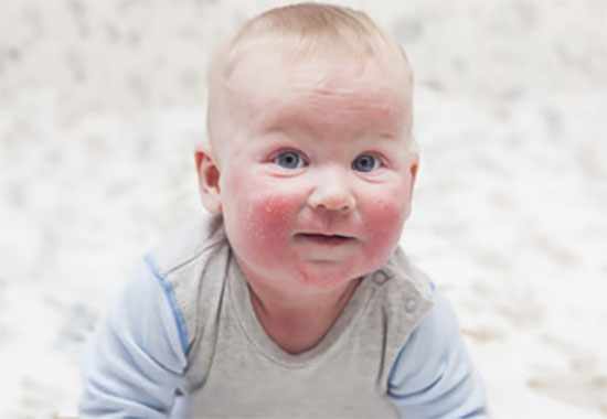 Ребенок с ярко выраженными признаками атопического дерматита на щеках