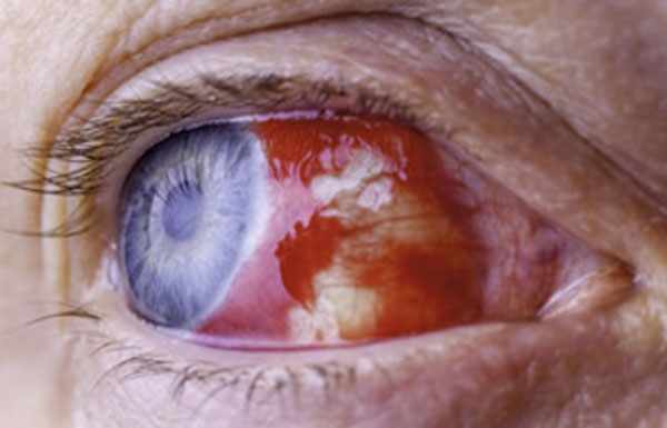 Кровоизлияние в глазу