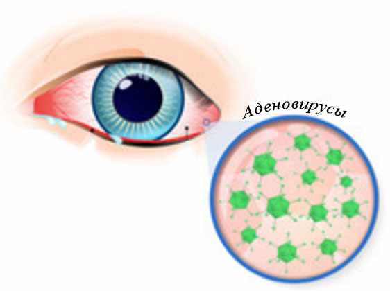 Инфицированный глаз и увеличенное изображение аденовирусов