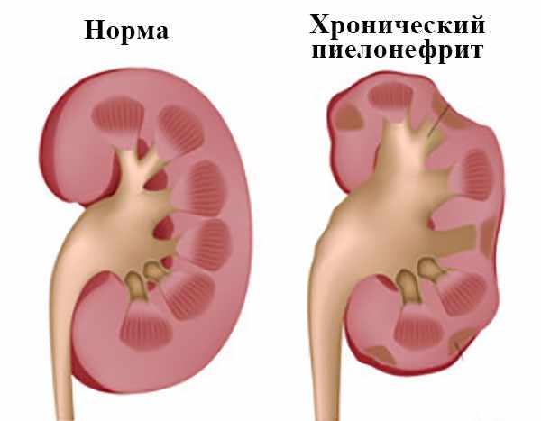 Изображение здоровой почки в разрезе и органа с хроническим пиелонефритом