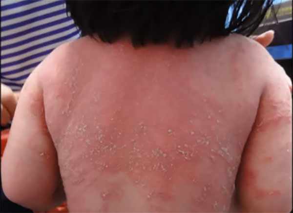 Проявления псориаза на спине ребенка