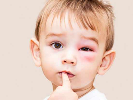 Ребенок с укусом осы возле глаза