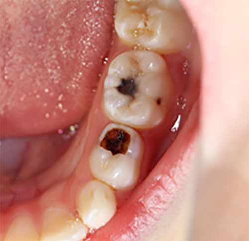Зубы, пораженные кариозными бактериями