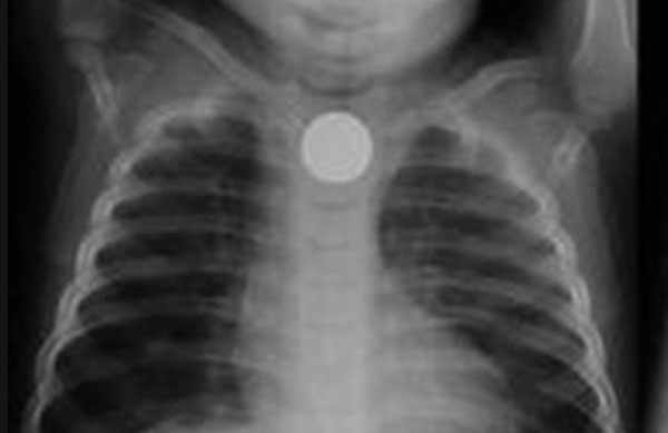 Рентген грудной клетки ребенка, на котором видна батарейка
