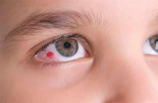 Ребенок с небольшим участком кровоизлияния в глазу