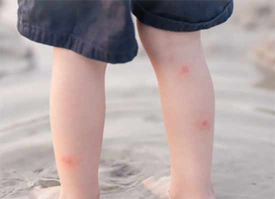 Ноги ребенка с укусами комаров
