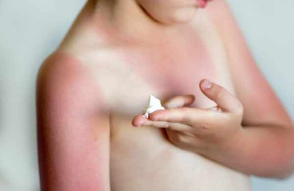 Ребенок после солнечного ожога держит мазь на пальчиках