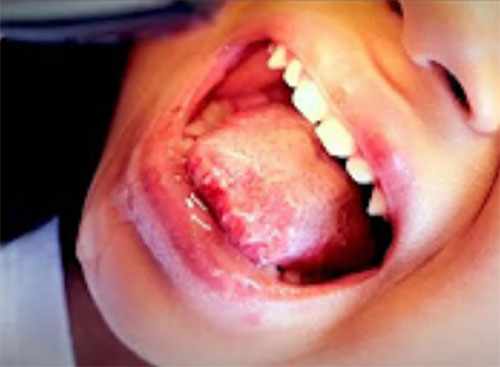 Язык ребенка с характерной сыпью для герпетического стоматита