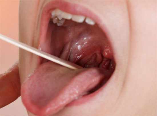 Ребенку осматривают горло, видно воспаление, гиперемия слизистой