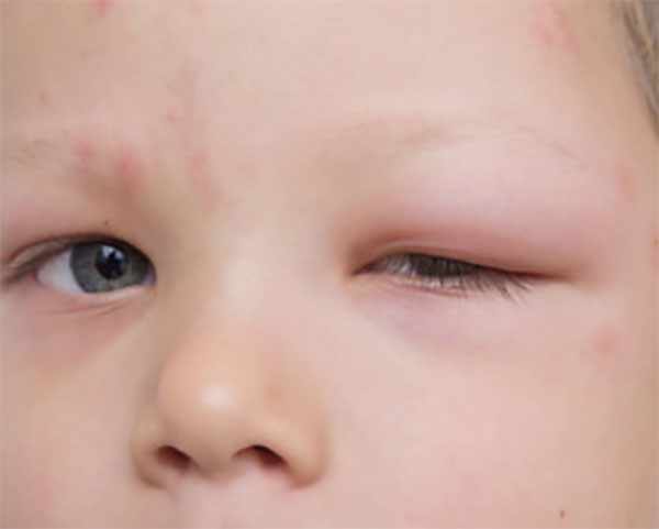 Лицо ребенка с заплывшим глазом (отек века)