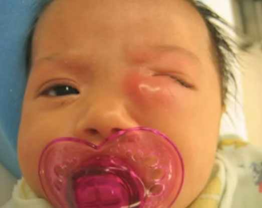 Ребенок с дакриоциститом на левом глазе