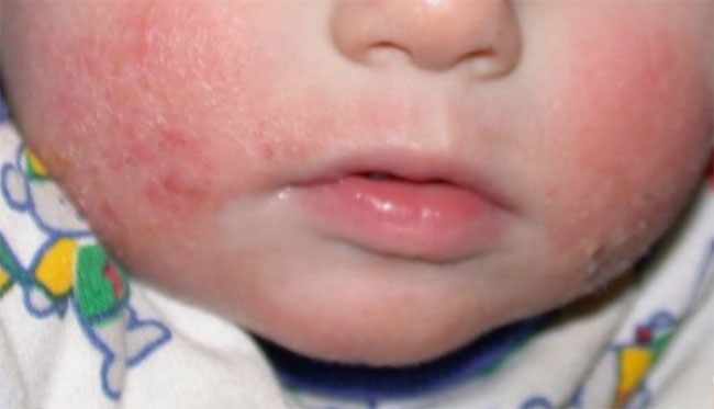Диатез на щеках у ребенка