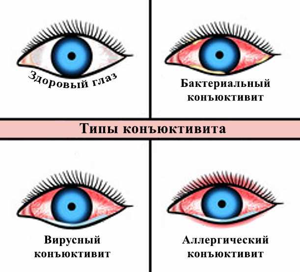 Картинка, на которой изображены здоровый глаз, а также с бактериальным, вирусным и аллергическим конъюнктивитом