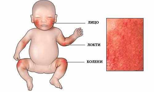 места проявления сыпи при аллергии у ребенка